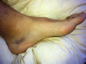 foot sprain